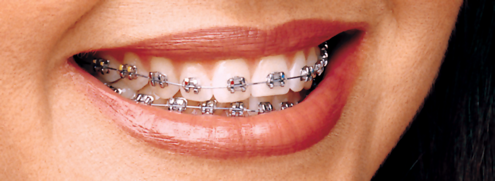 Dental Braces in Alexandria VA Hughes Orthodontics