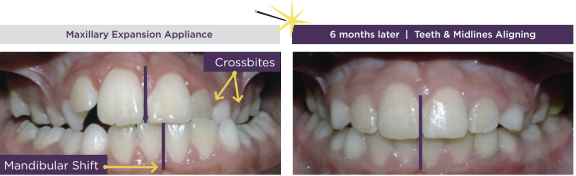 Crossbite Hughes Orthodontics in Alexandria, VA