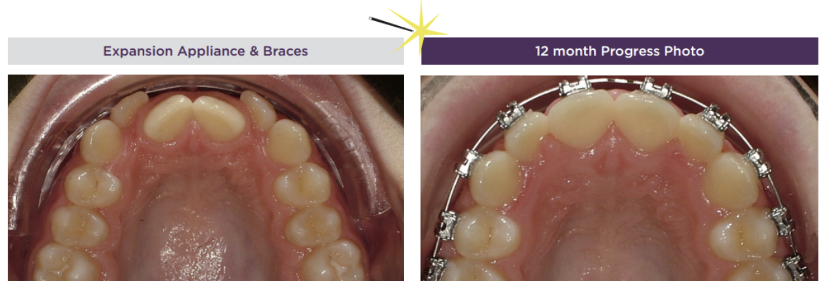 Crowding Hughes Orthodontics in Alexandria, VA