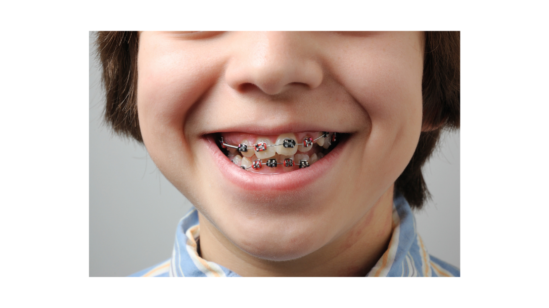 Kinds braces