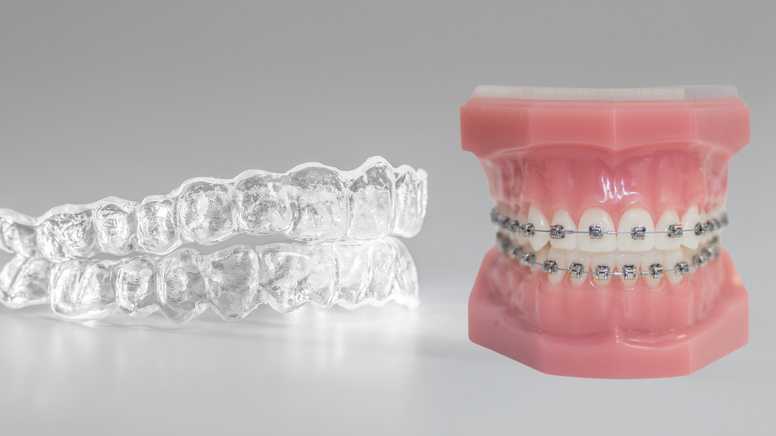 Braces or aligners