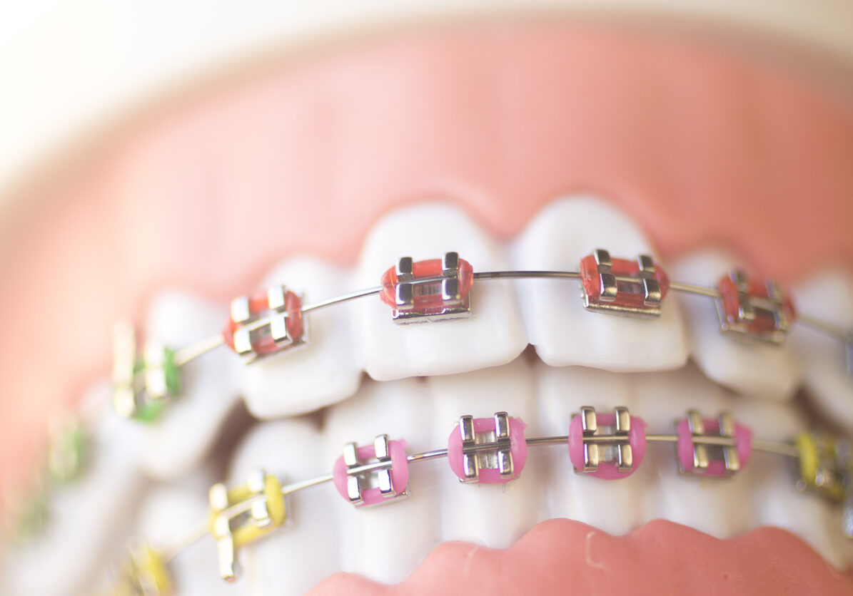 Close up of a model mouth with braces and wires and brackets.